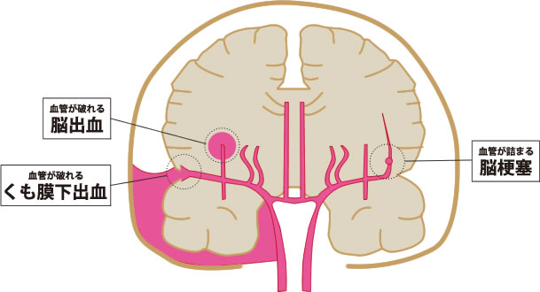 脳卒中とは？